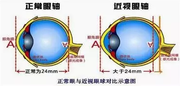 近視眼球突出？！控制近視度數(shù)加深是關(guān)鍵！