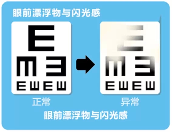 視網(wǎng)膜脫離啥癥狀？這張圖告訴你！