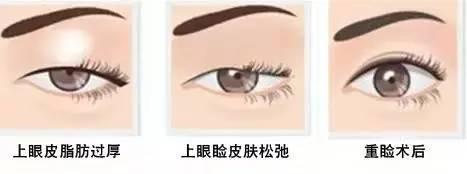 為什么要做雙眼皮？5個(gè)理由說服你！