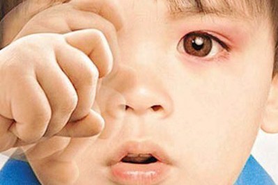 秋季紅眼病高發(fā)，當(dāng)心孩子被傳染