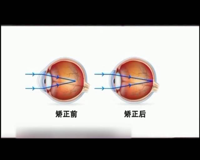 一夜之間真的能改變視力嗎？