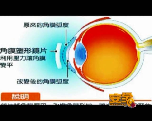 一夜之間真的能改變視力嗎？