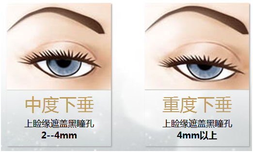 拯救惺忪睡眼，告別上瞼下垂！